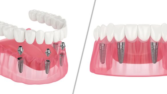All-on-4 Dental Implants: An Overview for Candidates