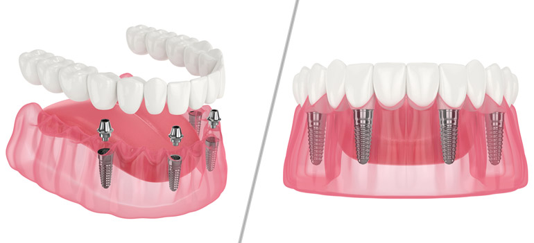 All-on-4 Dental Implants: An Overview for Candidates