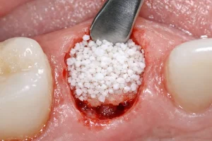 Atraumatic Tooth Extraction with Socket Preservation