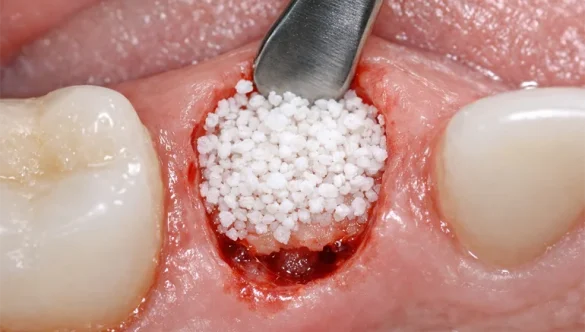 Atraumatic Tooth Extraction with Socket Preservation