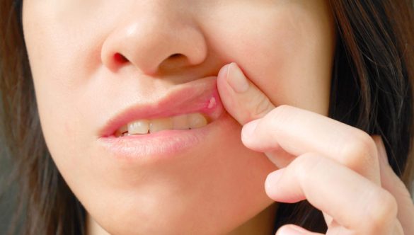 Comforting Cold sores, Canker sores, and other oral lesions with Laser