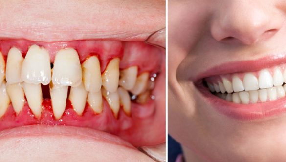 The Critical Connection: How Gum Health Influences Your Overall Well-being