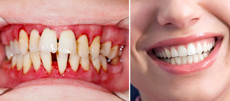 The Critical Connection: How Gum Health Influences Your Overall Well-being