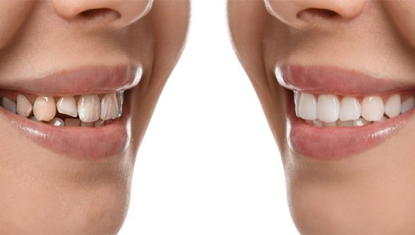 A Guide to Tailored Smile Makeovers