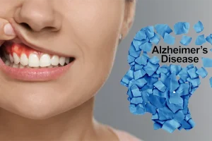 The Link Between Oral Bacteria and Alzheimer’s Disease