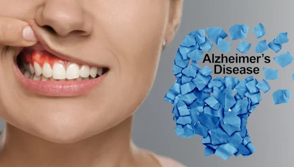 The Link Between Oral Bacteria and Alzheimer’s Disease