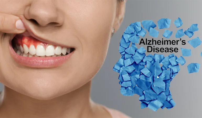 The Link Between Oral Bacteria and Alzheimer’s Disease