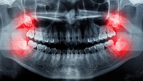 The Mesioangular Wisdom Tooth Causes Decay at the Second Molar