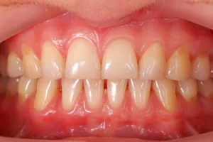 What Is Periodontal Charting and Why It’s Important for Your Oral Health