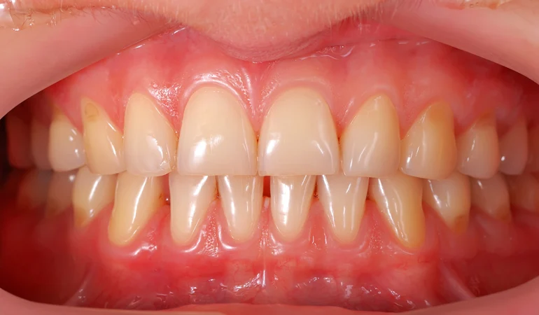 What Is Periodontal Charting and Why It’s Important for Your Oral Health