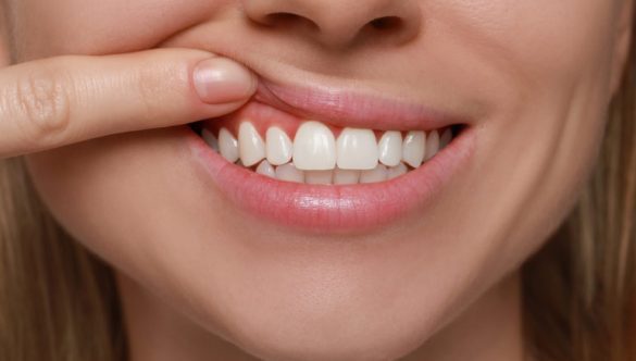 The Reasons Behind Soft & Spongy Gums