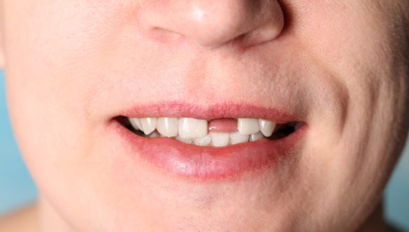 Replacing Missing Teeth