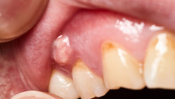 Understanding Tooth Abscesses and the Risks of Leaving Them Untreated