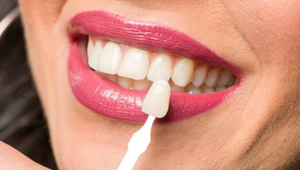 Transform Your Smile with Porcelain Veneers at Fort York Dentist in Downtown Toronto