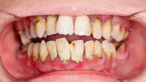 The True Cost of Underestimating Proper Periodontal Care with a Quick/Improper Cleaning