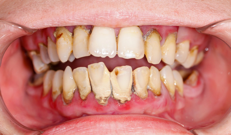 The True Cost of Underestimating Proper Periodontal Care with a Quick/Improper Cleaning