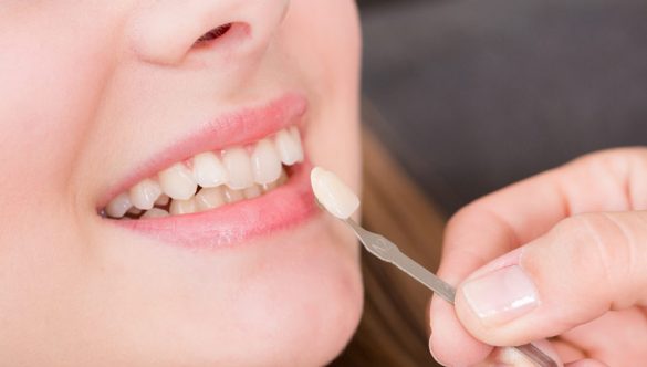 The Ultimate Guide to Porcelain Veneers