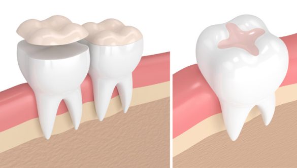Understanding Dental Inlays & Onlays: Which Is Right for You?