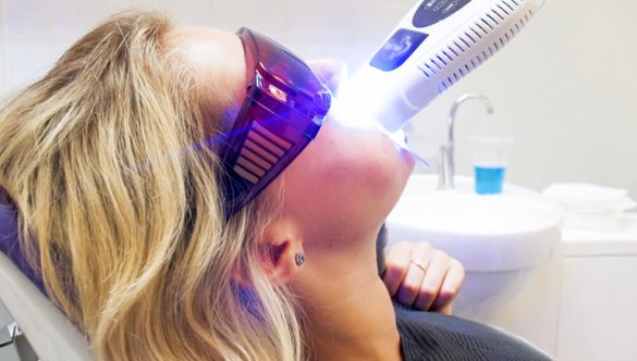 Understanding the Process of Laser Teeth Whitening