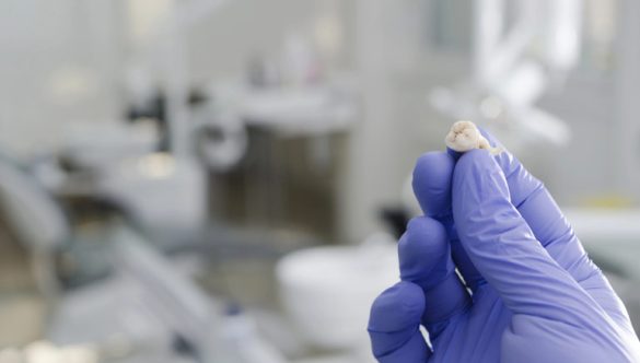 Understanding Tooth Extraction Without Discomfort