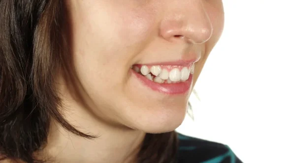 What Happens If Crooked Teeth Are Left Untreated?