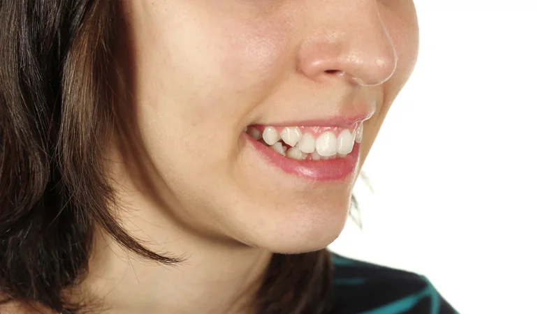 What Happens If Crooked Teeth Are Left Untreated?